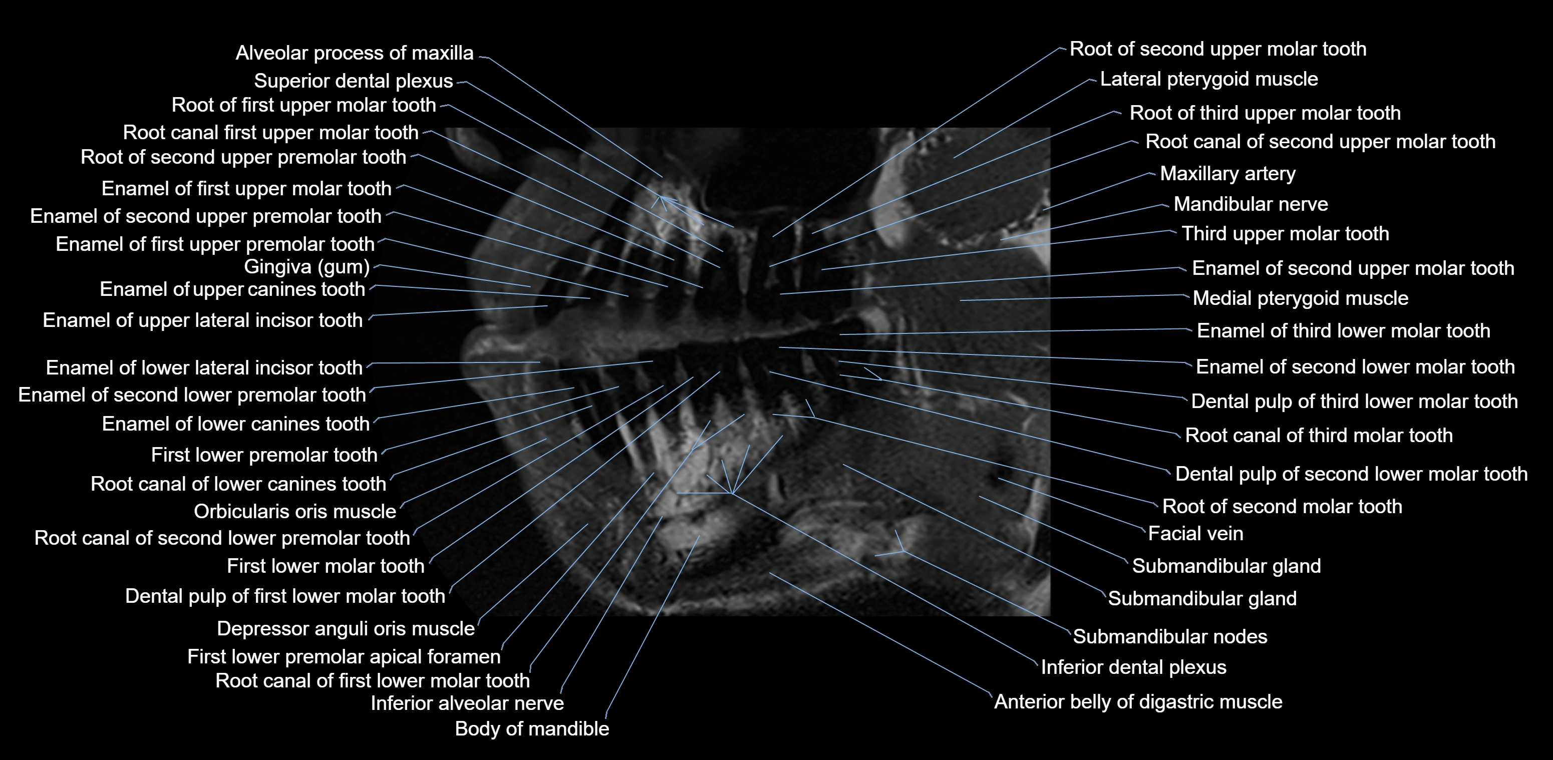 Dental MRI( tooth) sagittal labelled  cross sectional 3T anatomy -img-00001-00008.webp